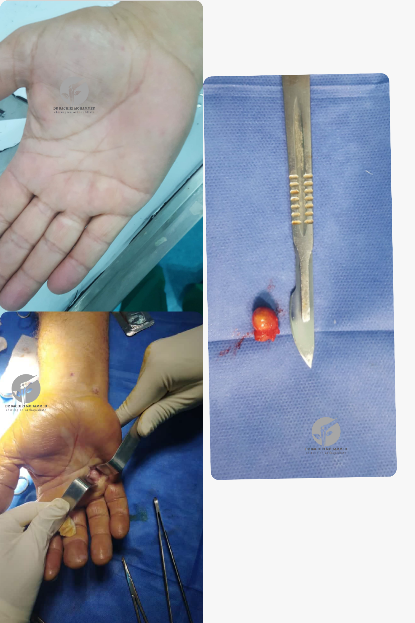 Nodule de la main (lipome) traité par Dr. Bachiri Mohammed à Oujda